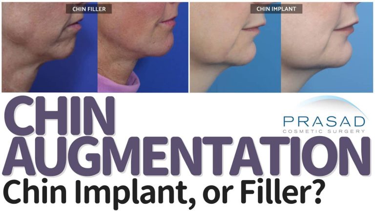chin augmentation - chin implant or filler
