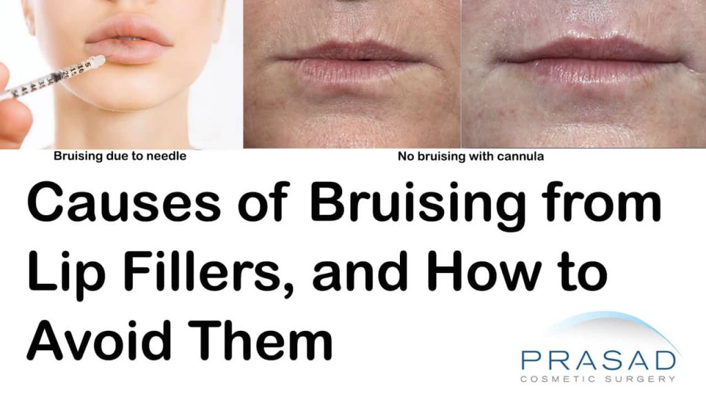 causes of bruising from lip fillers and how to avoid them