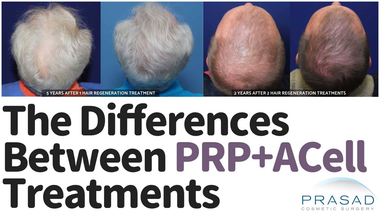 PRP and Acell for Hair Loss: Why Results Can Differ