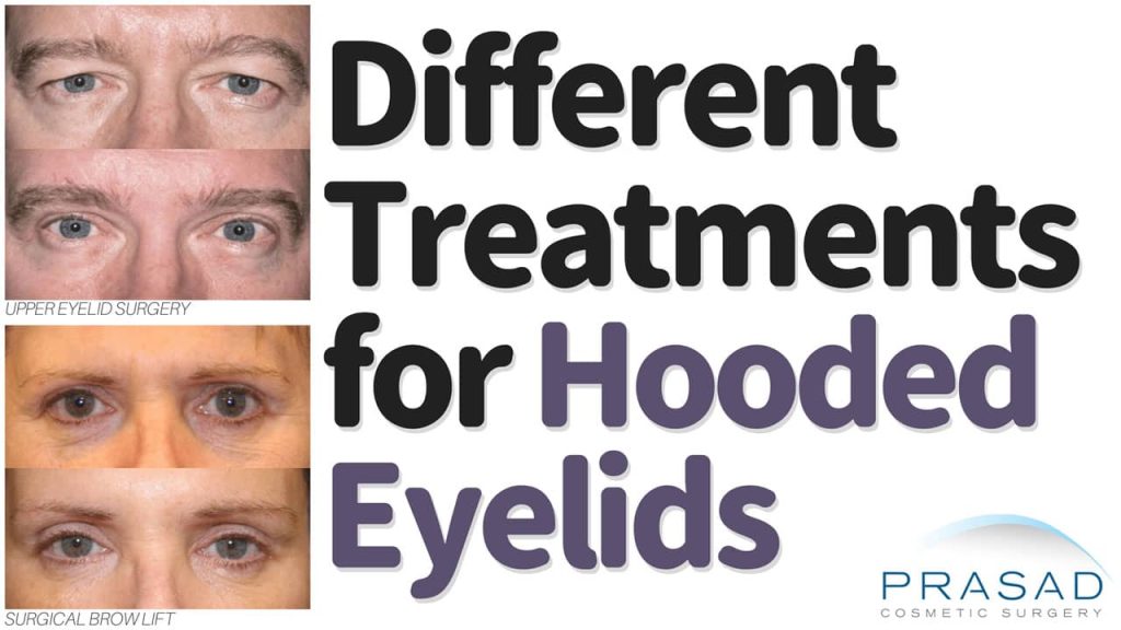 different treatments for hooded eyelids