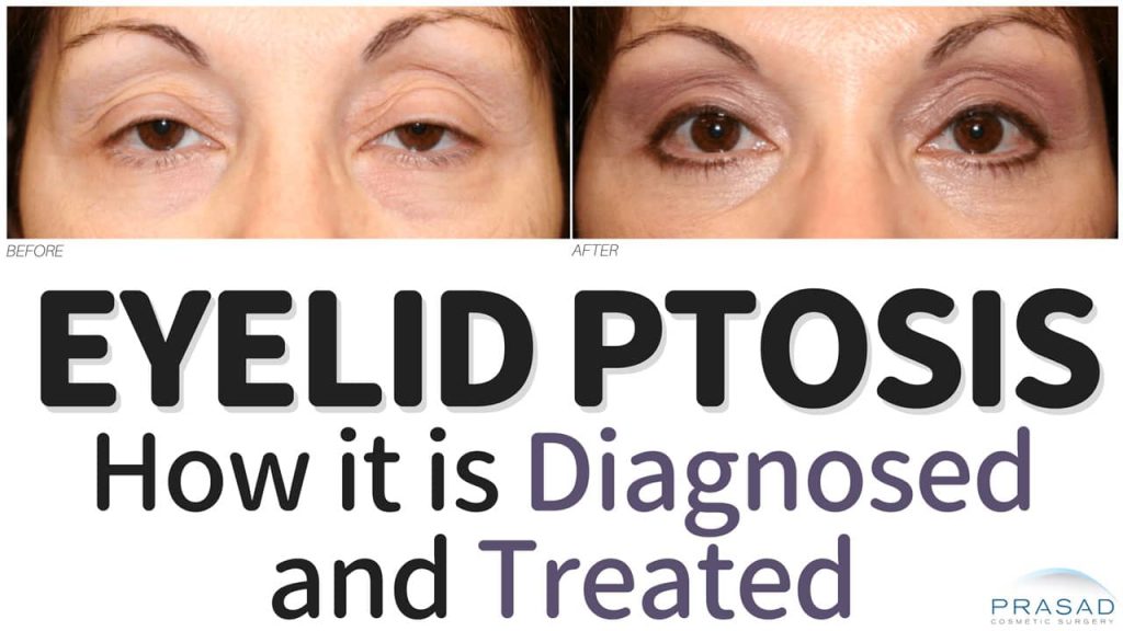 eyelid ptosis how it is diagnosed and treated