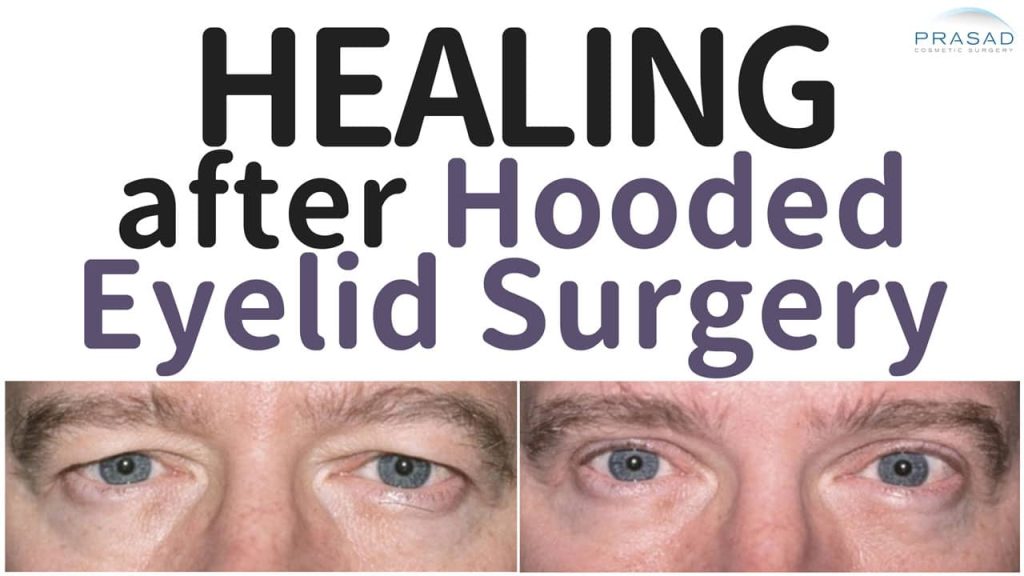 healing like after hooded eyelid surgery