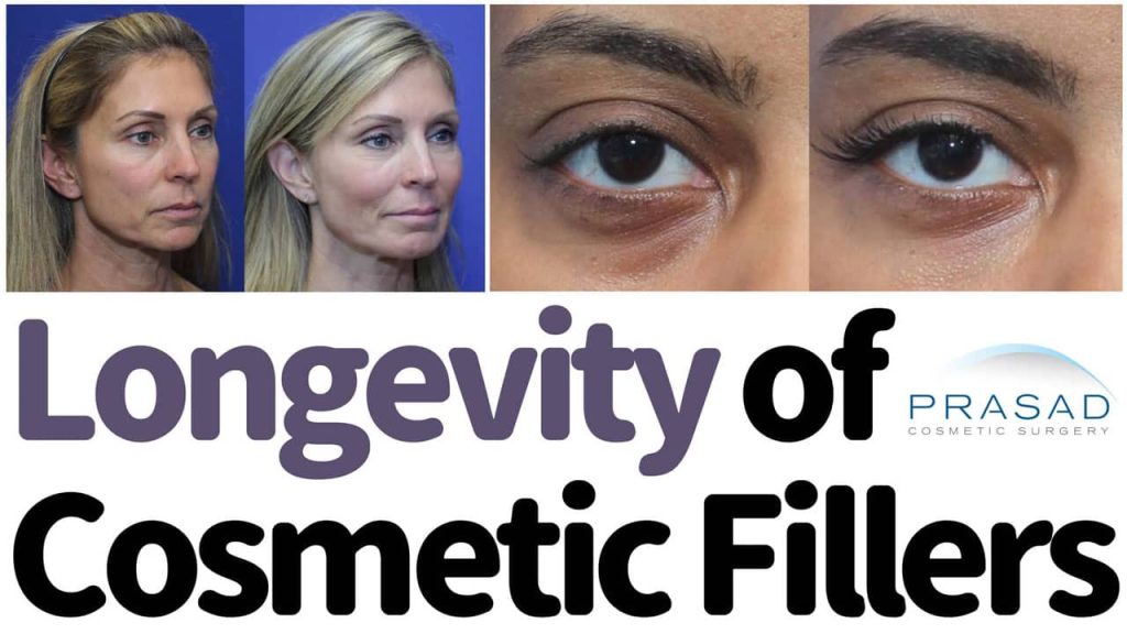 longevity of cosmetic fillers