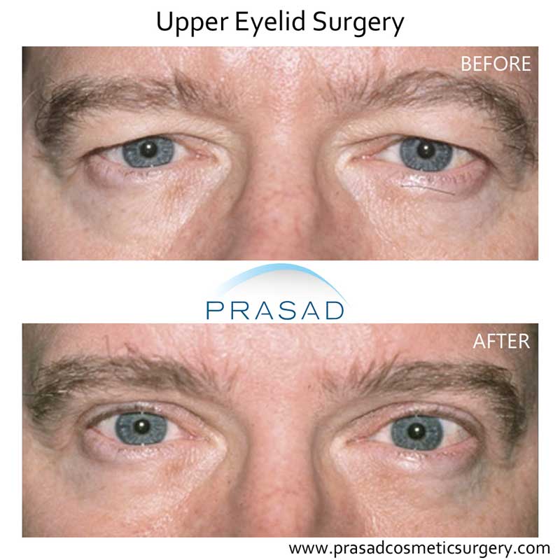 plastic surgery for hooded eyes, before and after results