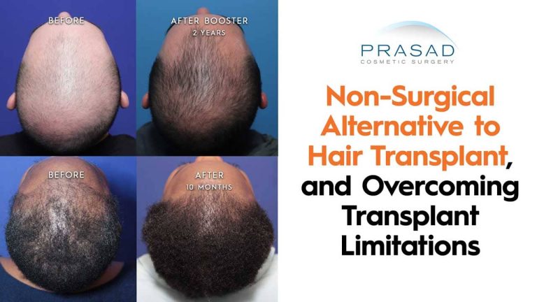 non-surgical alternative to hair transplant