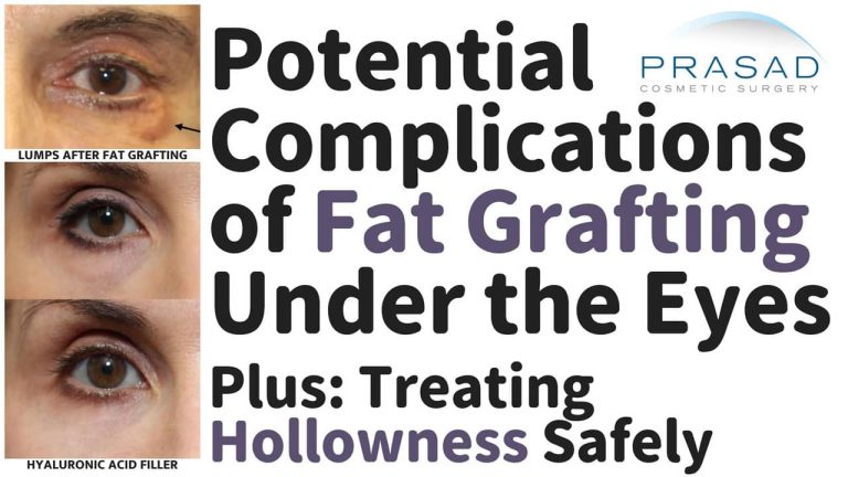 potential complications of fat grafting under the eyes