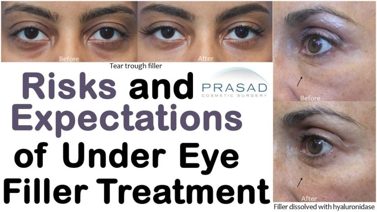 risks and expectation from under eye filler treatment