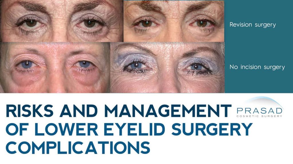 risks and management of lower eyelid surgery complications