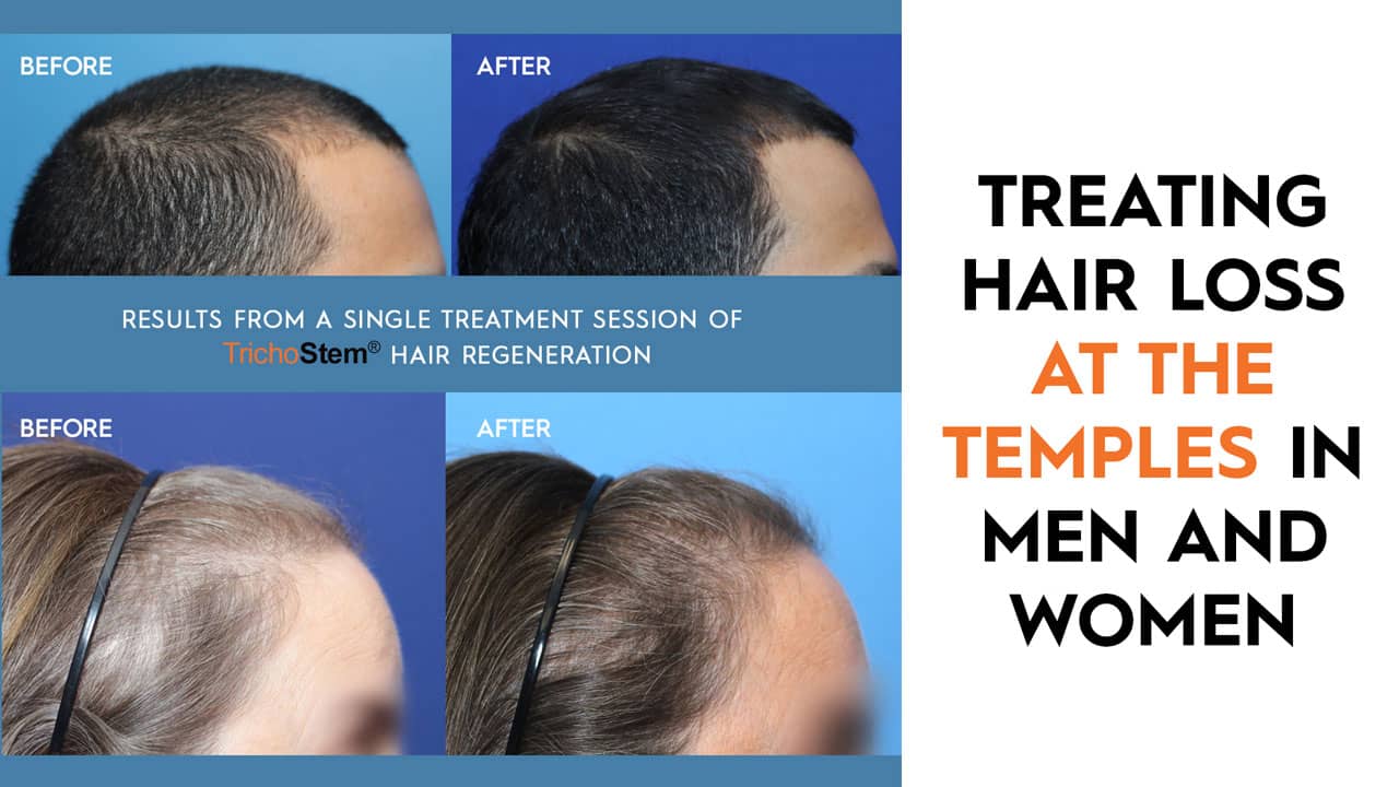 treating hair loss or hair thinning at the temples