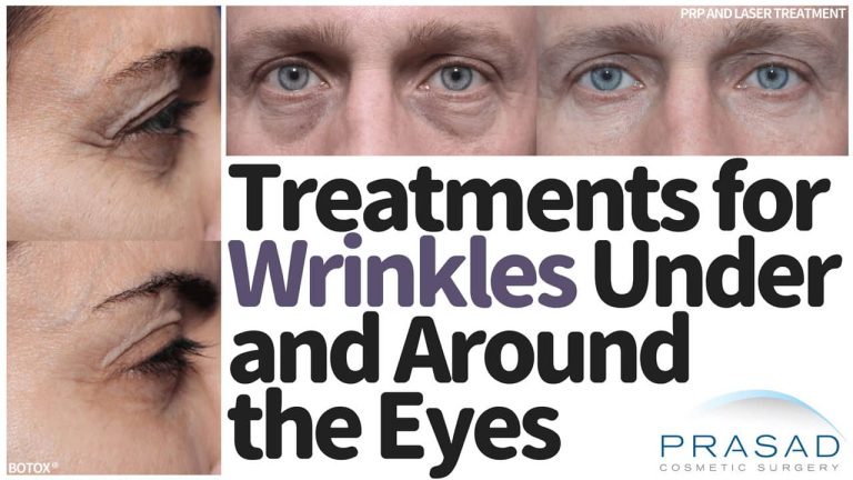 treatments for wrinkles around and under eyes