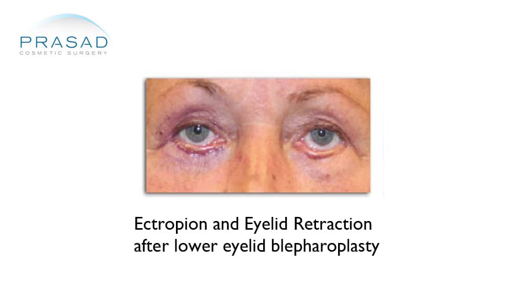 ectropion and eyelid retraction after lower eyelid surgery