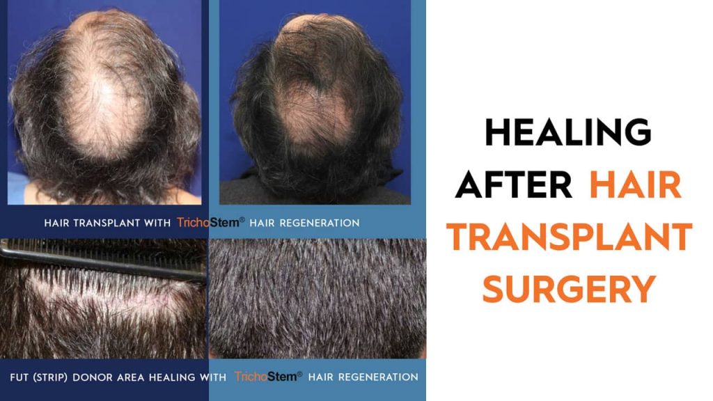 What is healing like after a hair transplant?