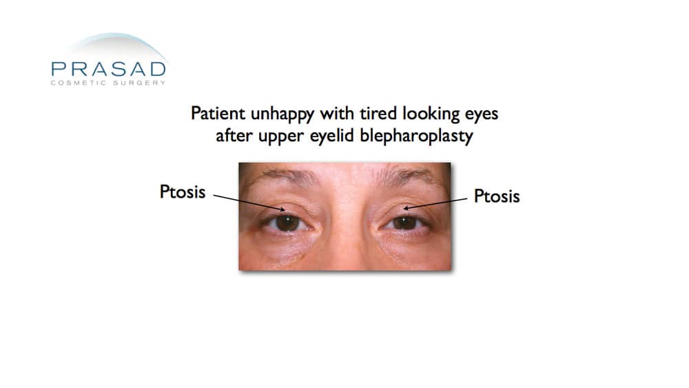 blepharoplasty patient who needed ptosis surgery