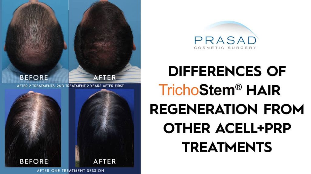 differences of trichostem hair regeneration from other acell + prp treatments