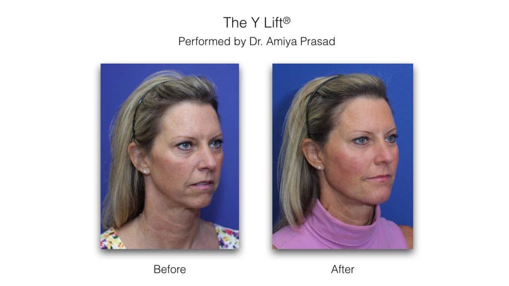 facelift without surgery before and after - y lift