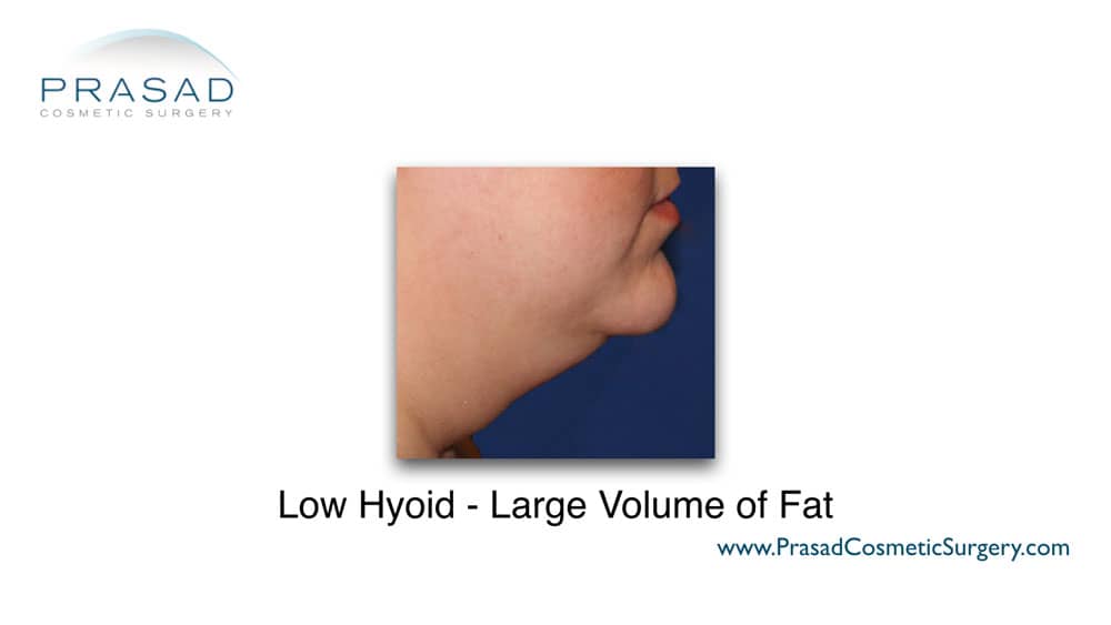 large volume fat under chin example