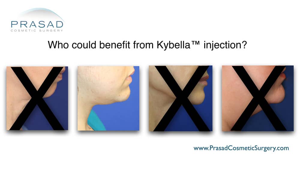 only one can benefit from kybella injection illustration