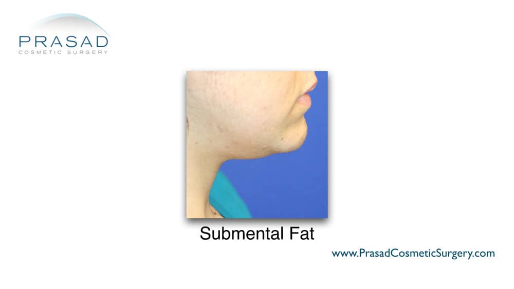 submental fat example