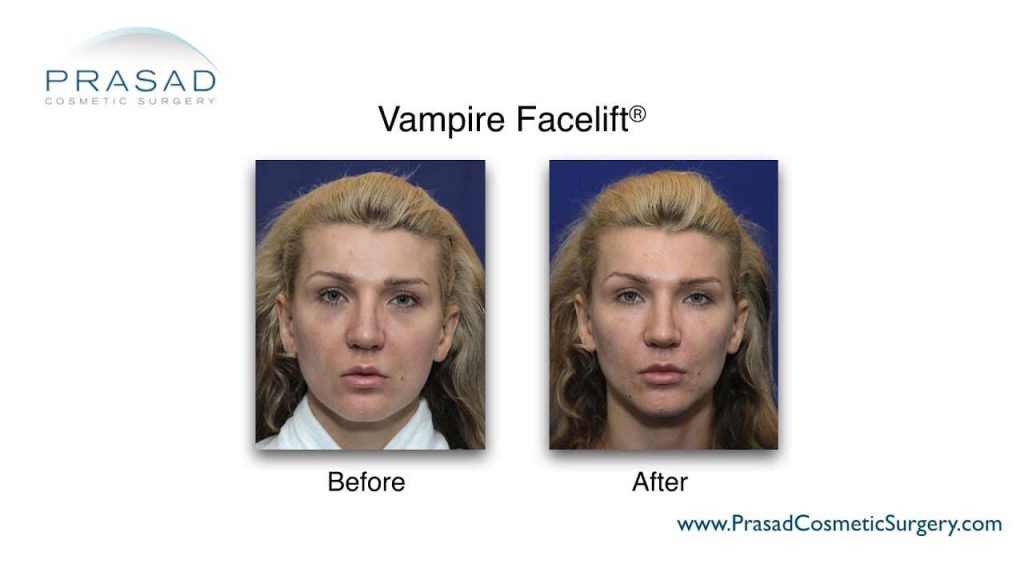 vampire facelift (prp facial) before and after