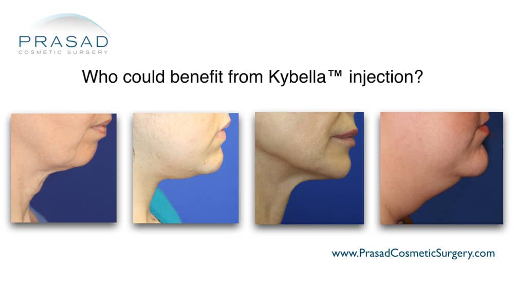 who could benefit from kybella injection illustration