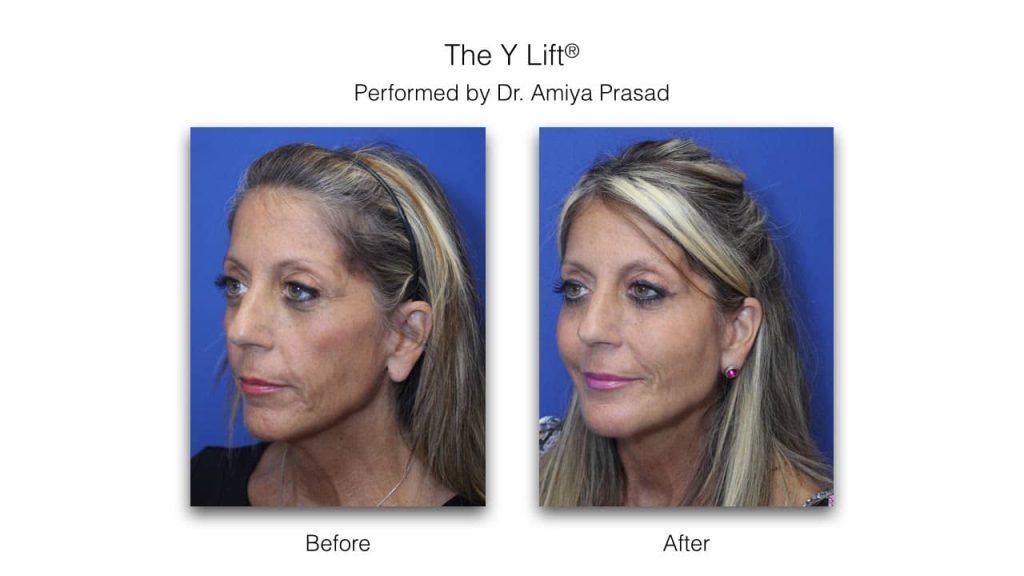 y lift before and after
