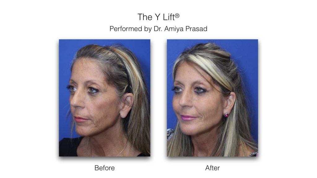 Y Lift® Non-Surgical Facelift - Dr. Amiya Prasad