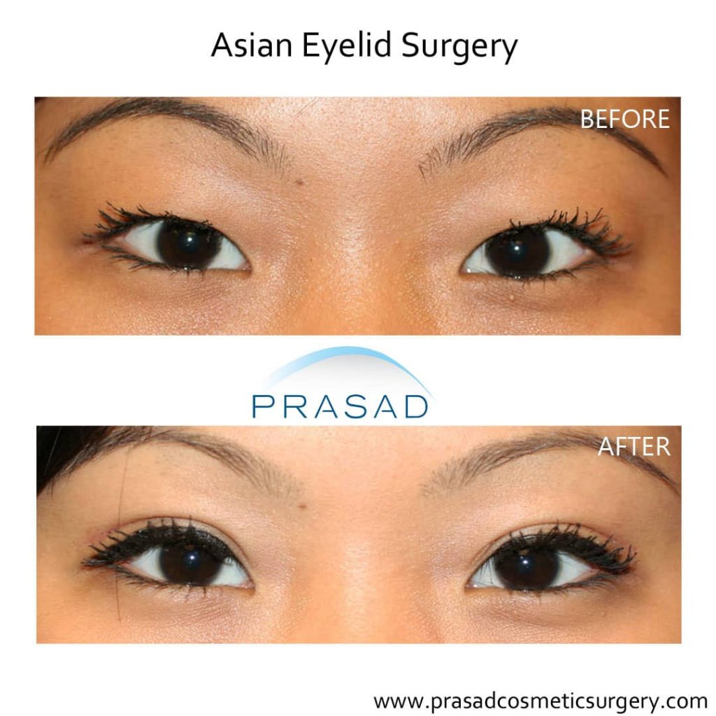 double eyelid surgery before and after results female patient