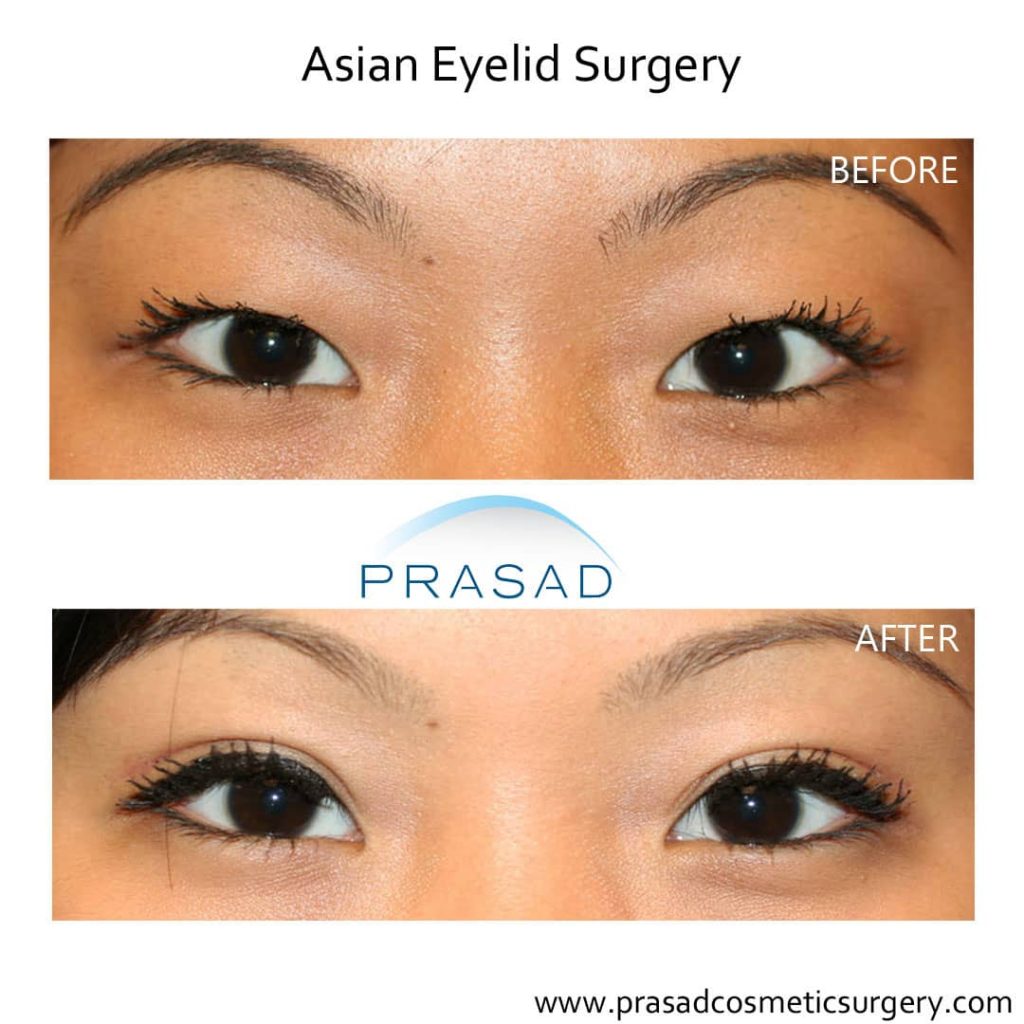 Non surgical double clearance eyelid