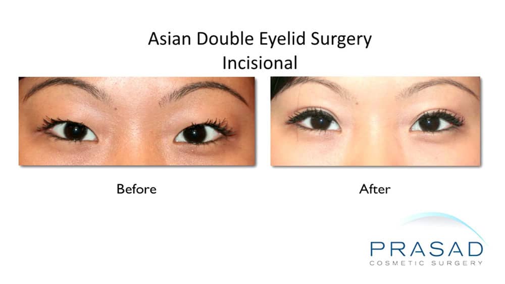 Double fold eyelid clearance surgery