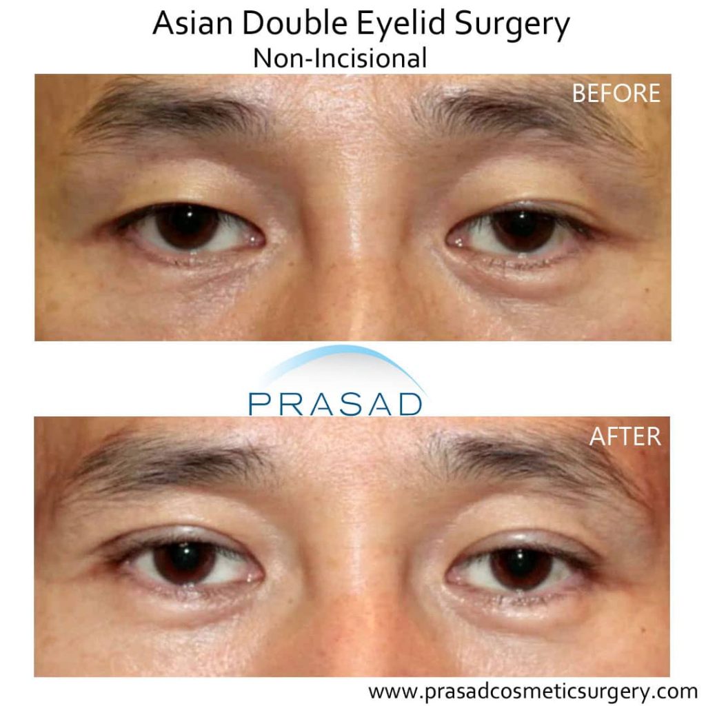 asian double eyelid surgery male before and after
