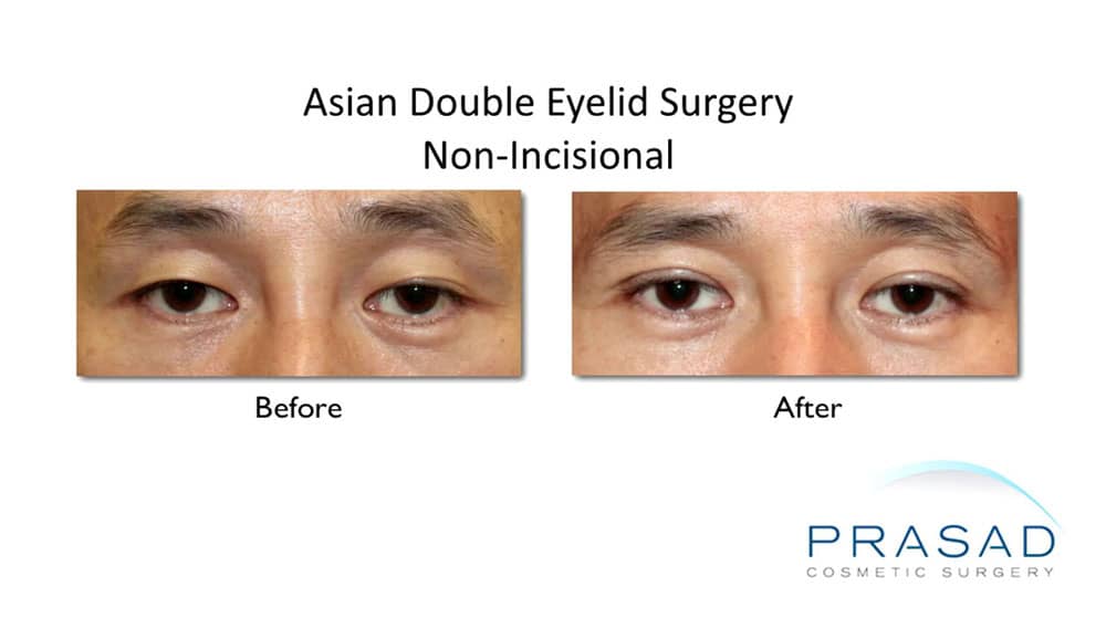 double eyelid surgery male patient before and after results
