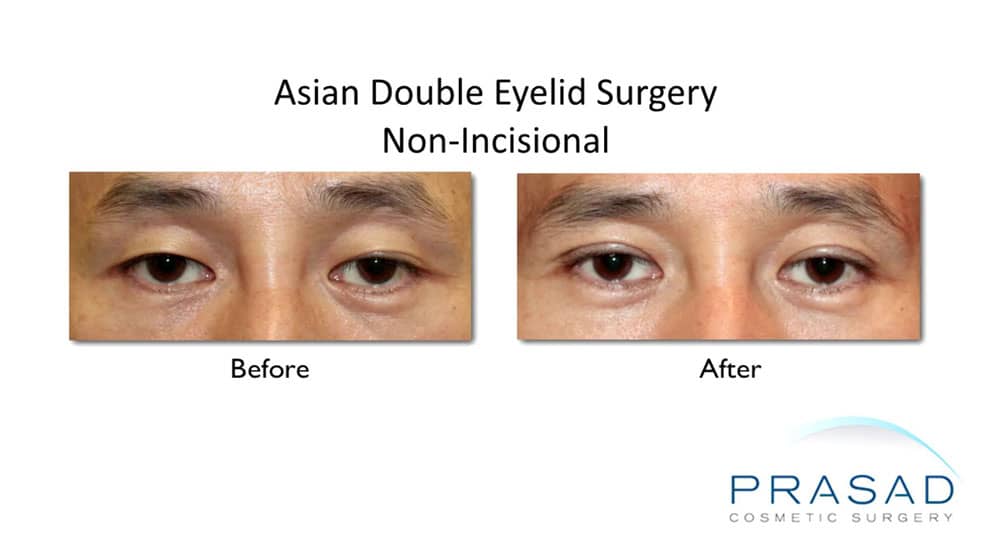 Double Eyelid Surgery (Asian Eyelid Surgery) in New York