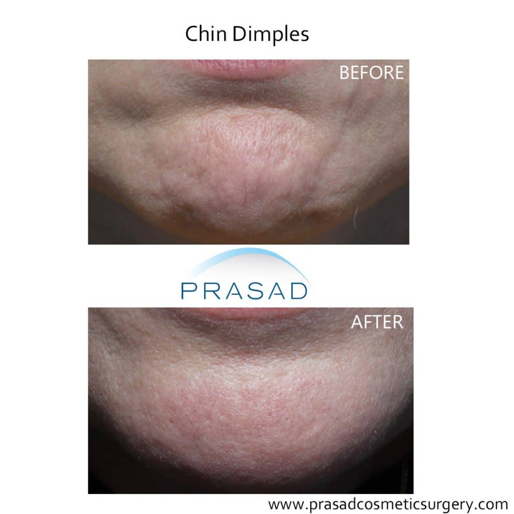 chin dimples before and after treatment