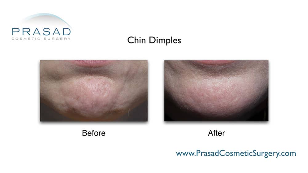 Chin dimpling treated with Botox® by Dr. Amiya Prasad