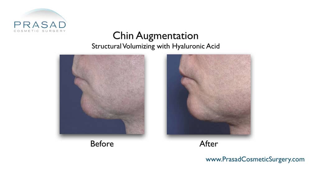 chin augmentation using fillers before and after treatment