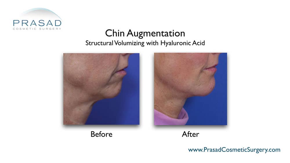 chin projection filler before and after results