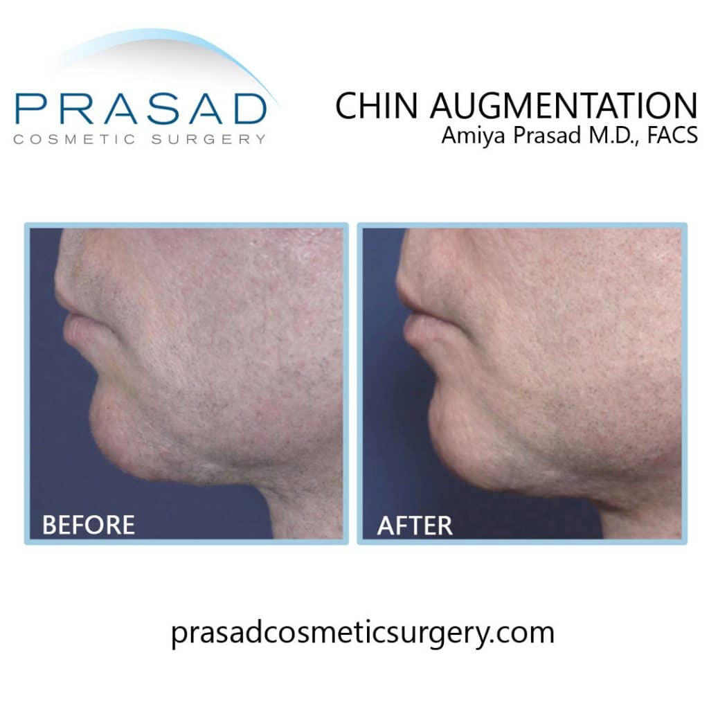 before and after chin augmentation filler by Dr Amiya Prasad