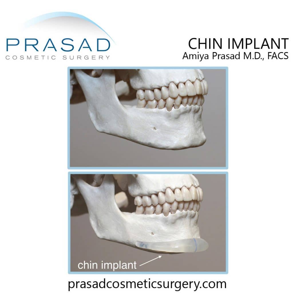 silicone chin implant anatomical placement illustration