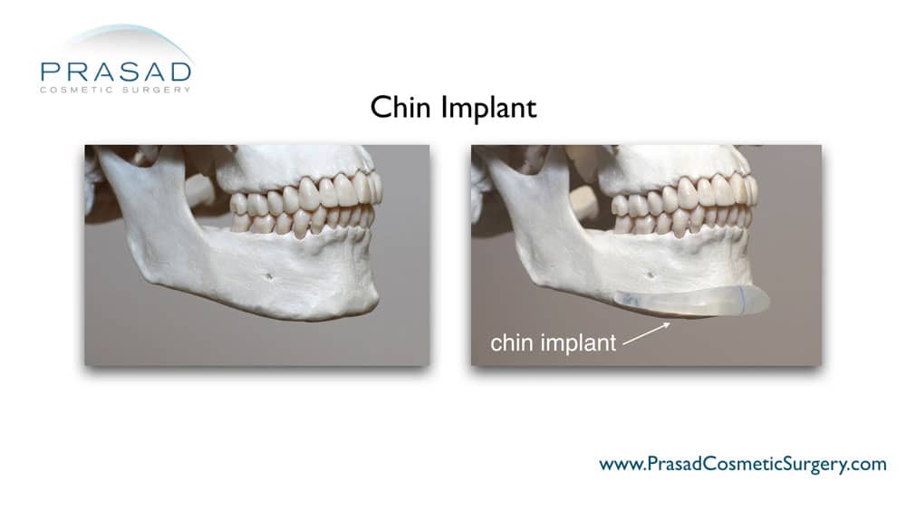 silicone chin implant anatomical placement illustration