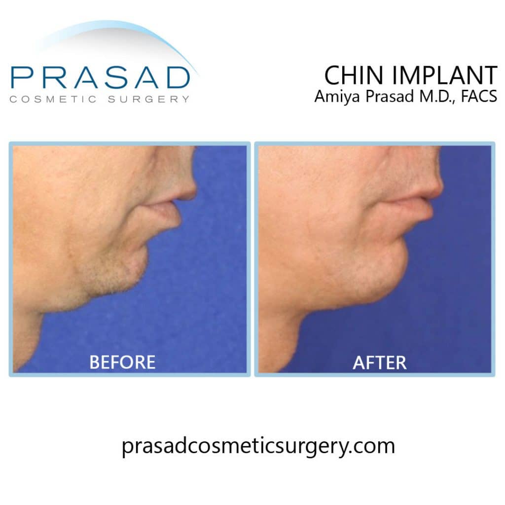 chin implant surgery in male before and after surgery - right side view