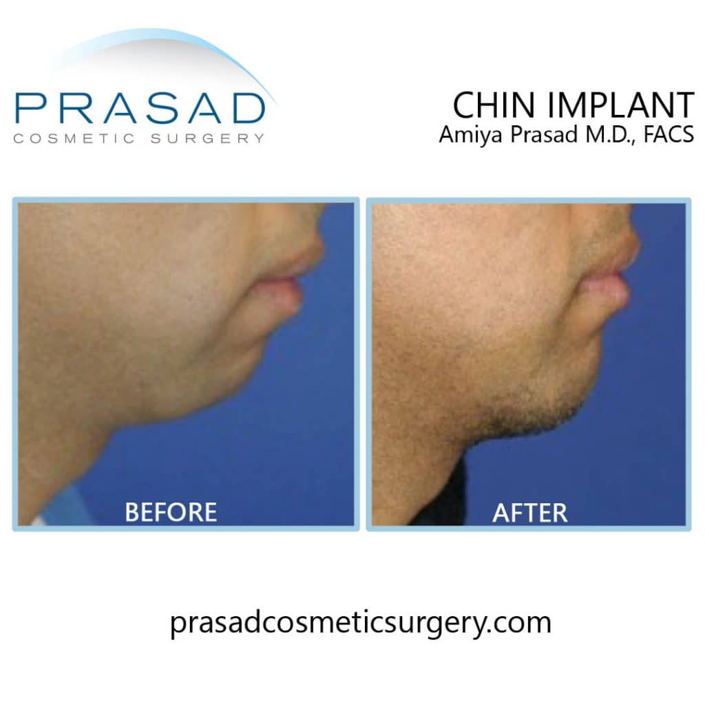 chin implant in male before and after surgery by Dr Amiya Prasad