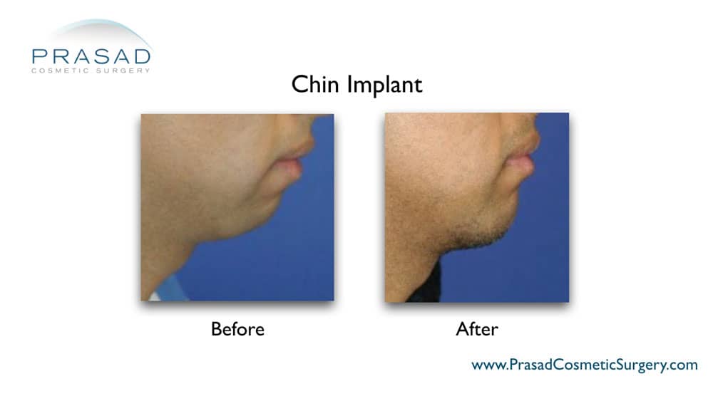 chin implant in male before and after surgery by Dr Amiya Prasad