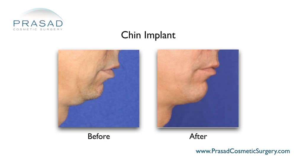 chin implant surgery in male before and after surgery - right side view