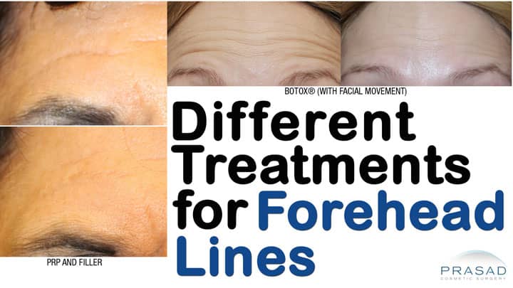 different treatments for forehead wrinkles