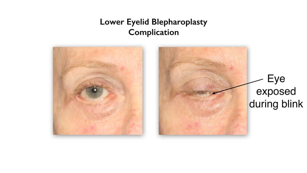 complication after lower eyelid surgery