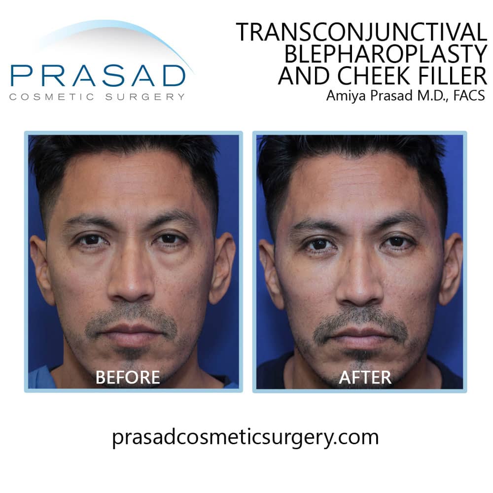 best surgical treatment for bags under eyes before and after results