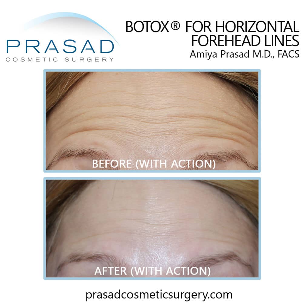 botox for forehead lines wrinkles