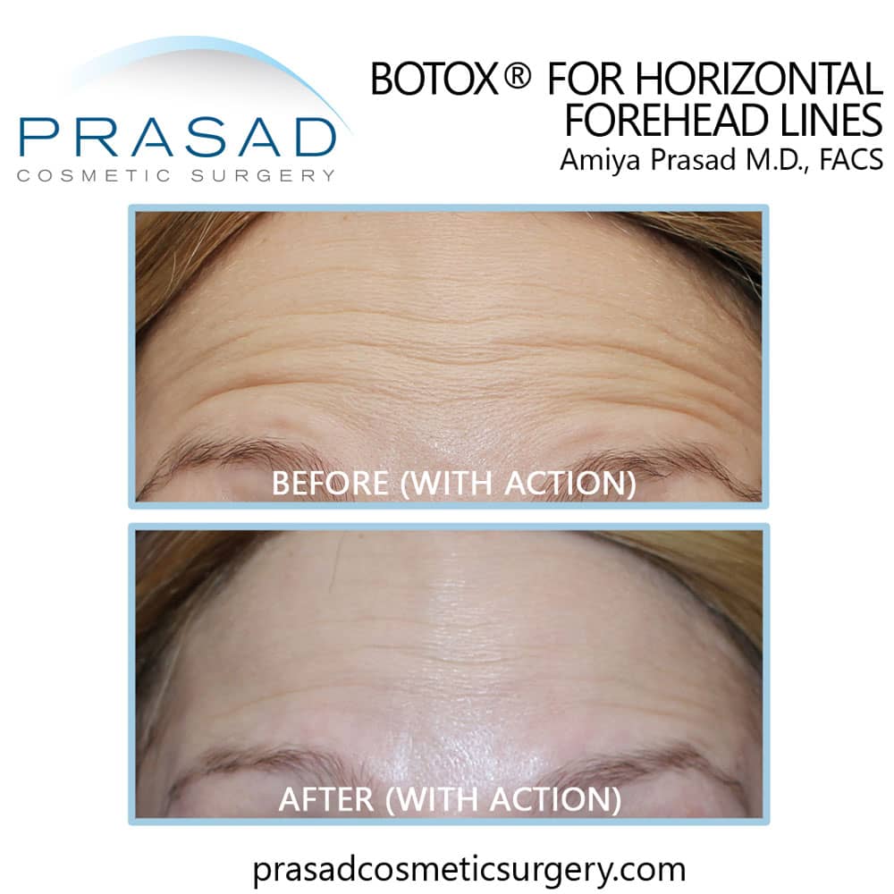 How to Get Rid of Forehead Wrinkles Dr. Amiya Prasad Blog