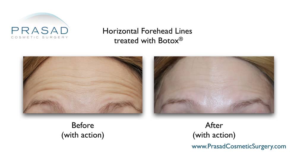 botox for forehead lines wrinkles