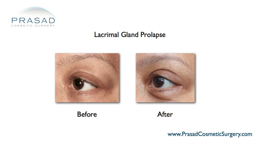lacrimal gland prolapse before and after